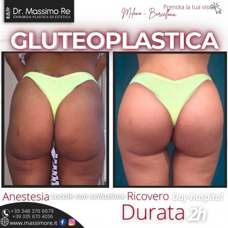 Gluteoplastica dott. Massimo Re